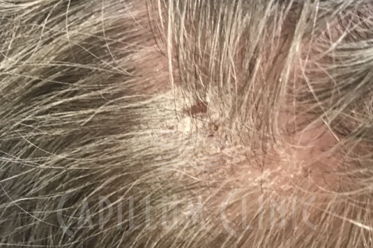 Псориаз кожи головы: фото до и после | Capillum Clinic